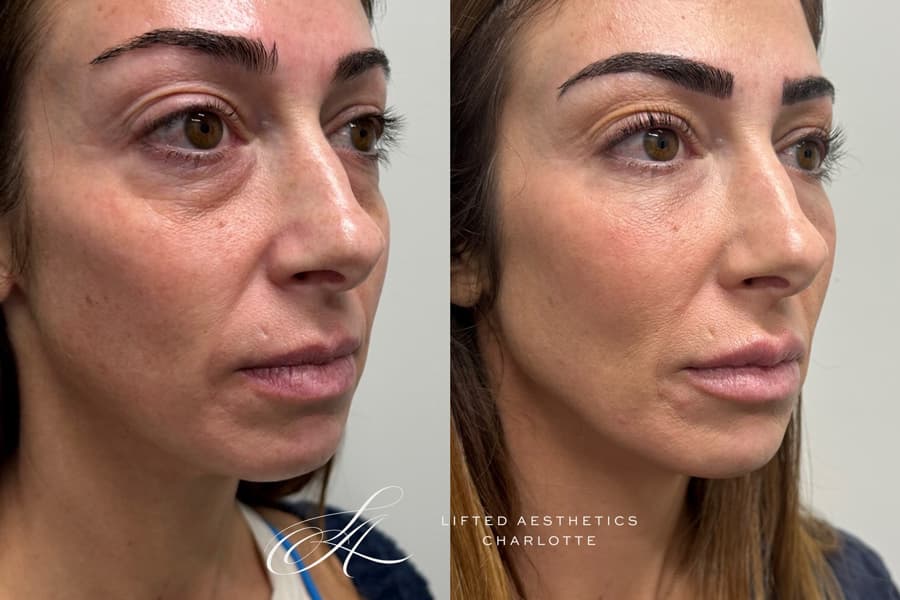 Before/after treatment results showing facial improvement