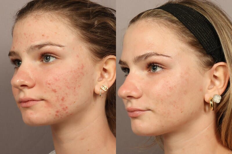 Before and after acne treatment results